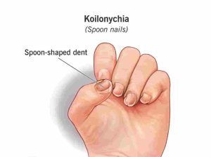 5 Weird Signs of Iron Deficiency You Shouldn’t Ignore