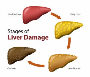 Can Fatty Liver Be Reversed? What You Should Know
